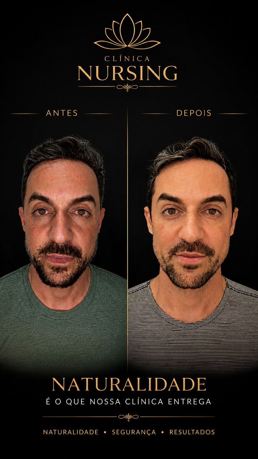 Evolução de resultado facial masculino em acompanhamento estético personalizado