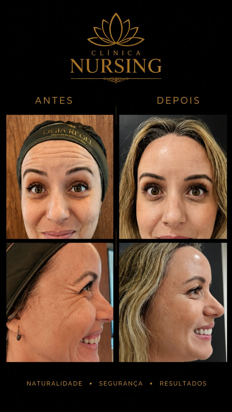 Comparação antes e depois de resultado facial personalizado